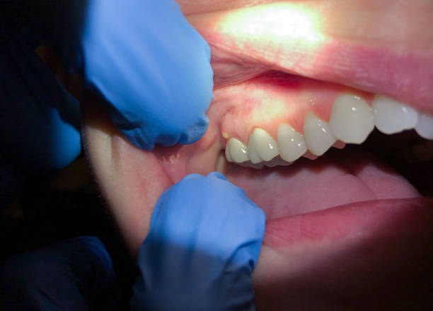 Best Emergency Tooth Extraction in Blue Mound, TX